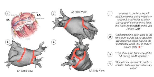 atrial fibrillation ablation 2.PNG