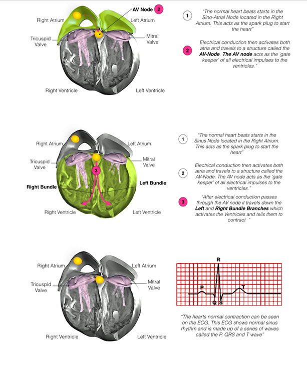 biventricular icd 1.PNG