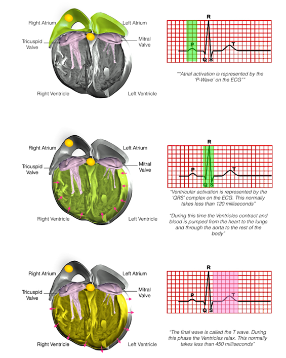 biventricular icd 2.PNG