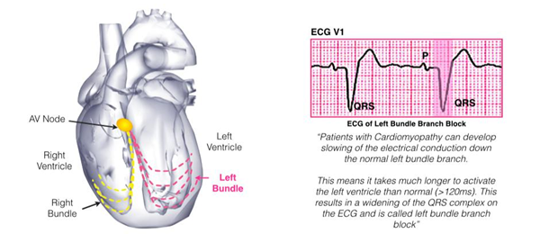 biventricular icd 3.PNG