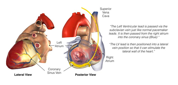 biventricular icd 4.PNG