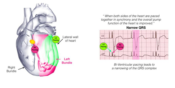 biventricular icd 5.PNG