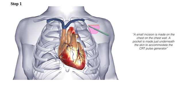 biventricular icd 6.PNG