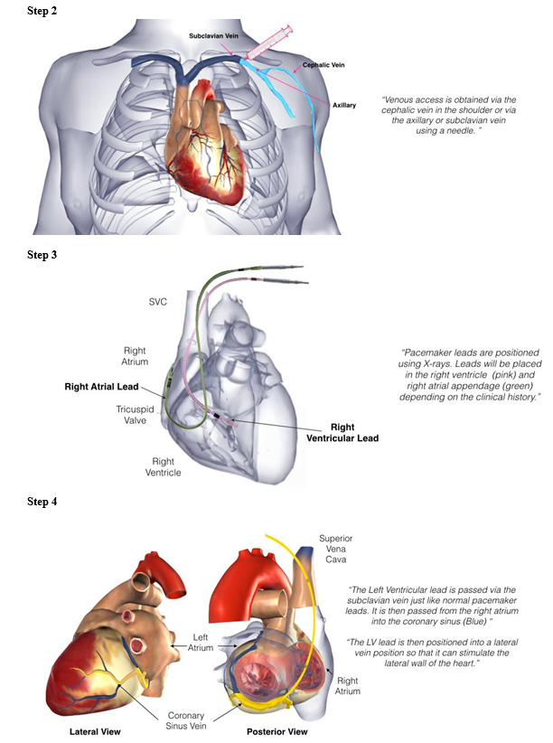 biventricular icd 7.PNG