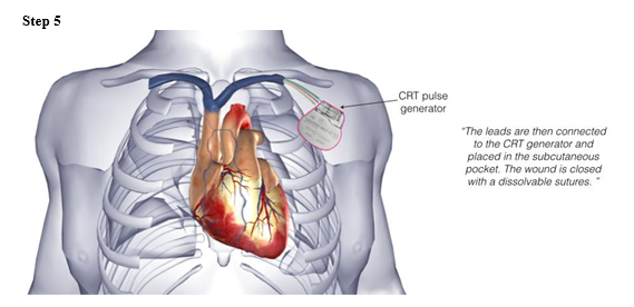 biventricular icd 8.PNG
