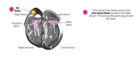 biventricular icd.PNG
