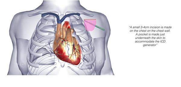 icd 1.PNG